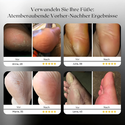 Suaveza™ | Elektrischer Hornhautentferner