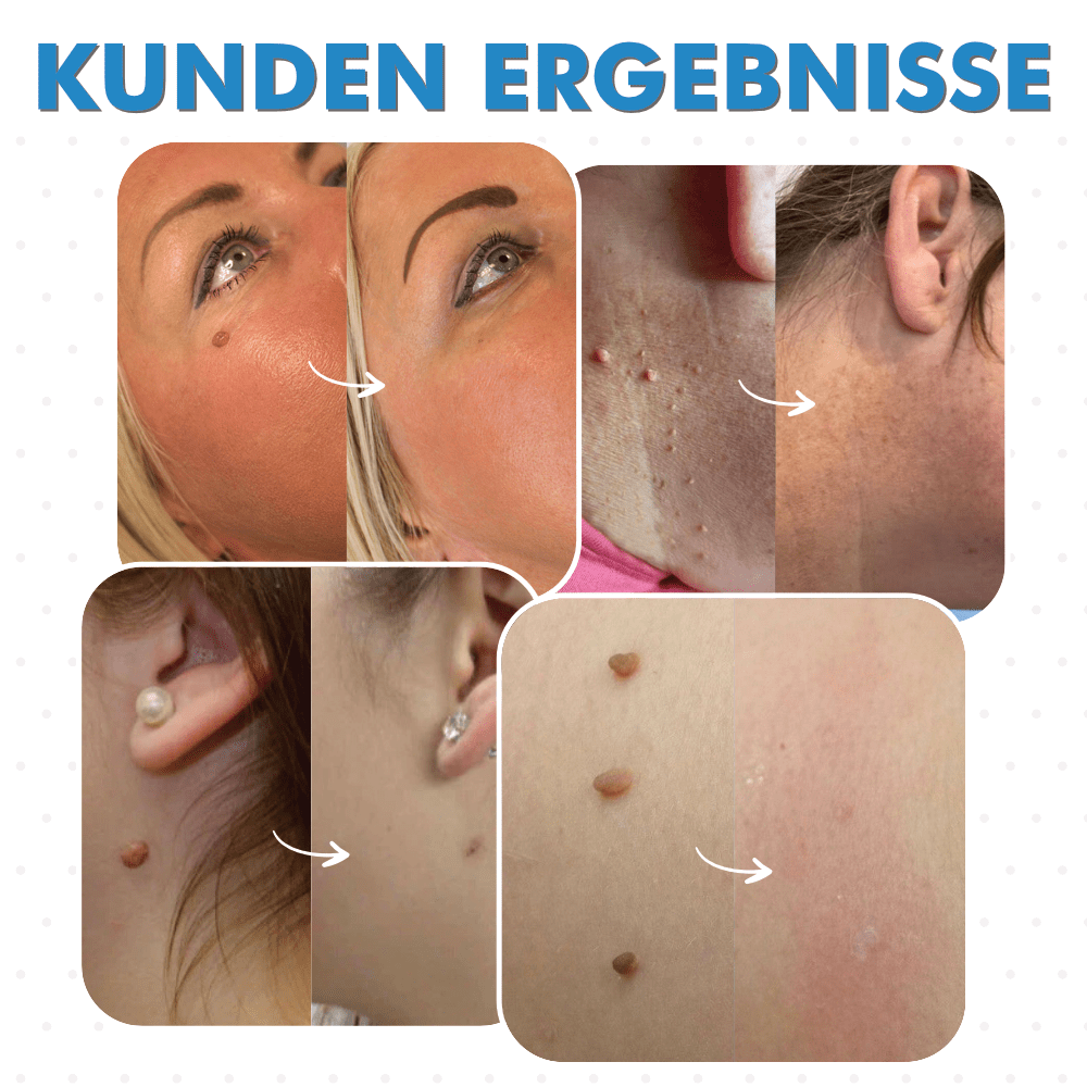 TagLift™ | fast skin clearing