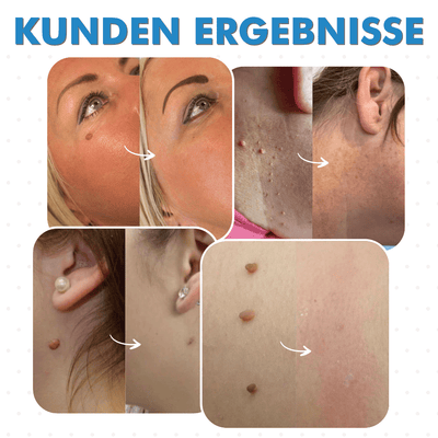 TagLift™ | fast skin clearing