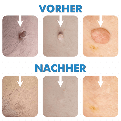 TagLift™ | fast skin clearing